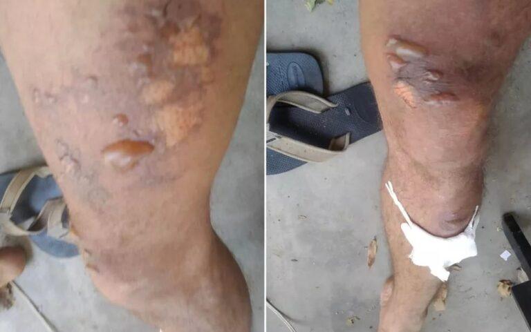 Brigadista fica ferido ao cair no fogo enquanto ajudava no combate ao incêndio na Chapada dos Veadeiros
