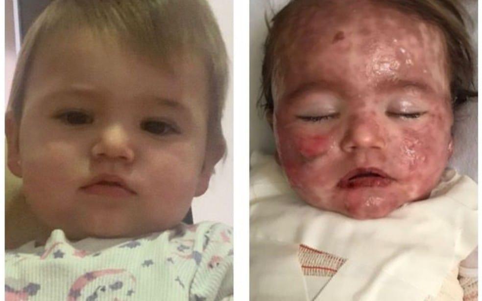 Uma bebê de pouco mais de 1 ano de vida foi intubada após ter 72% do corpo coberto por queimaduras causadas por reação a remédio.