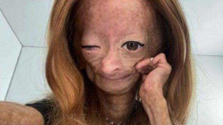 Youtuber com síndrome de Benjamin Button morre aos 15 anos