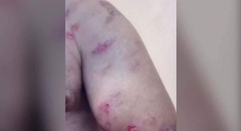 Britânico é picado centenas de vezes por aranhas dentro de casa
