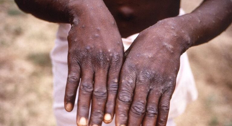 Governo cria comissão para acompanhar “varíola de macaco”