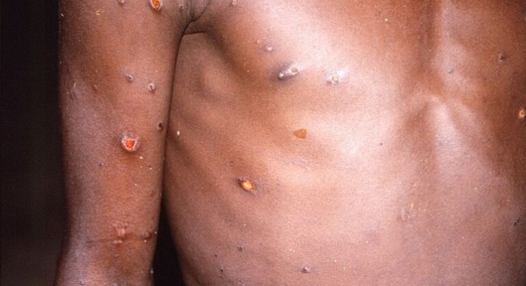 Varíola dos macacos e hepatite aguda desconhecida: o que se sabe e como se proteger