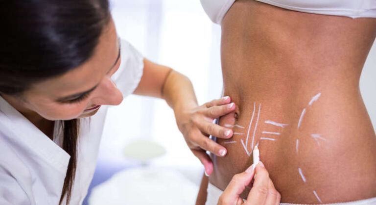 Abdominoplastia e lipoaspiração não são tratamentos para perder peso, alerta especialista
