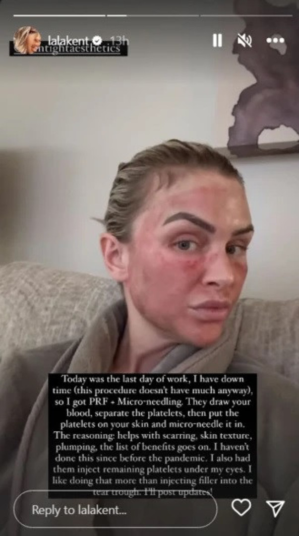 Lala Kent mostra-se com o rosto vermelho após procedimento estético