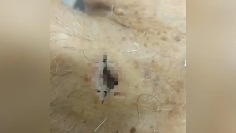 Família diz ter encontrado larvas em pescoço de paciente que morreu em hospital de Goiás