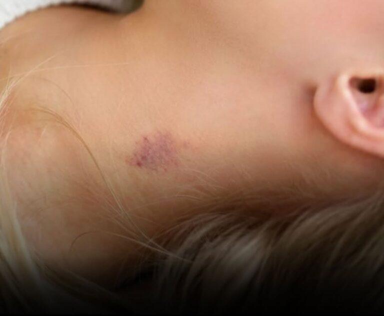 Chupão no pescoço pode causar coágulos e levar uma pessoa a ter um AVC