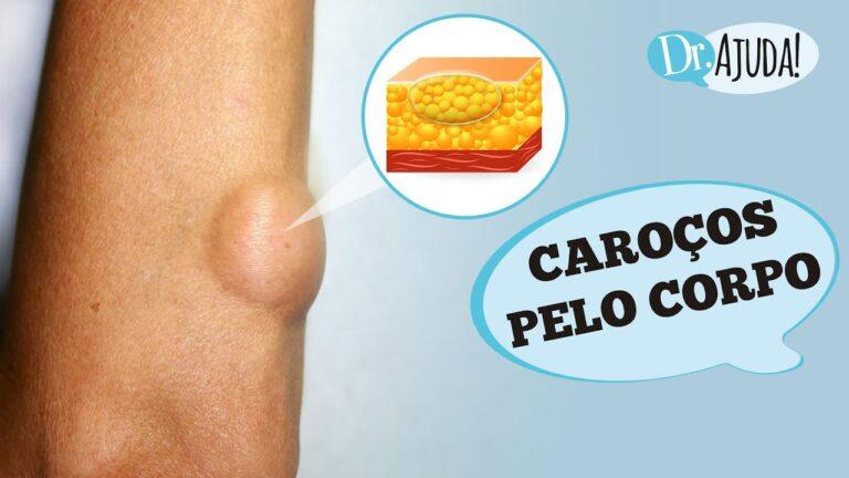 Caroços pelo corpo e lipoma: O que são? O que reparar?