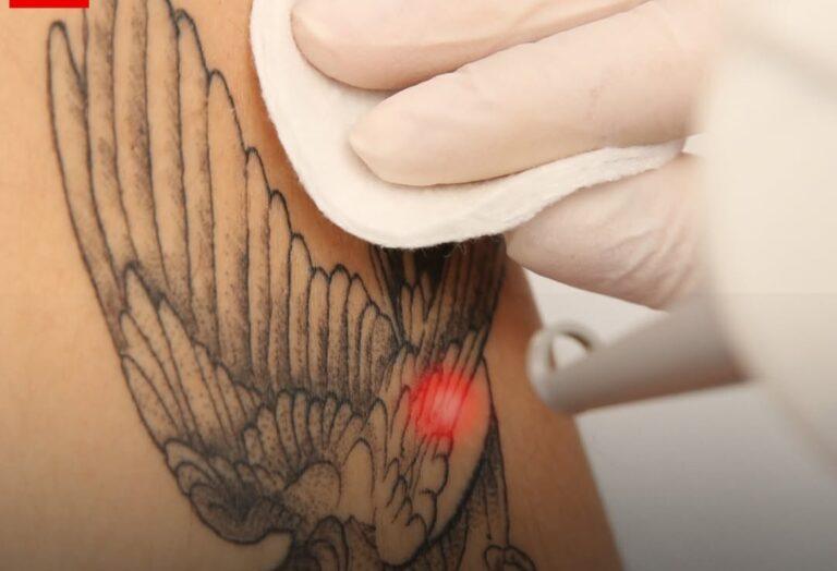 “Minha pele de volta” Por que as pessoas estão  removendo tatuagens?