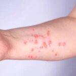 Mpox: Brasil registra 140 casos em 2026