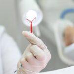 Governo de Goiás realiza mutirão de DIU em Goiânia e Aparecida